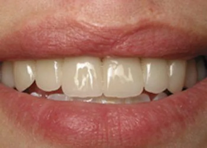 After treatment. Advanced tooth decay restored with crowns and veneers on patient with cleft lip.