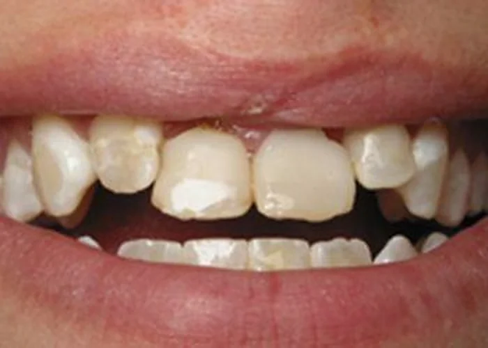Before treatment. Advanced tooth decay restored with crowns and veneers on patient with cleft lip.